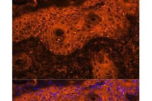 Immunofluorescence analysis of Human skin cancer using TYR Polyclonal Antibody at dilution of 1:100. (TYR 抗体)