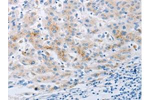 The image on the left is immunohistochemistry of paraffin-embedded Human liver cancer tissue using ABIN7191702(NPY2R Antibody) at dilution 1/20, on the right is treated with synthetic peptide. (NPY2R 抗体)