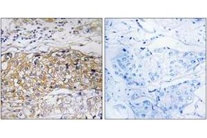 Immunohistochemistry analysis of paraffin-embedded human breast carcinoma tissue, using USP24 Antibody. (USP24 抗体  (AA 21-70))