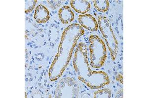 Immunohistochemistry of paraffin-embedded human kidney cancer using MAP2 Antibody. (MAP2 抗体)