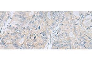 Immunohistochemistry of paraffin-embedded Human colorectal cancer tissue using APOBR Polyclonal Antibody at dilution of 1:35(x200) (APOBR 抗体)