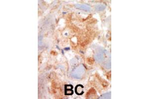 Immunohistochemistry (IHC) image for anti-Mast/stem Cell Growth Factor Receptor (KIT) antibody (ABIN5014921) (KIT 抗体)