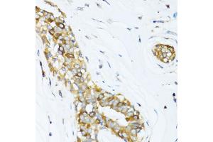Immunohistochemistry of paraffin-embedded human breast cancer using DCTN2 antibody (ABIN5971226) at dilution of 1/100 (40x lens). (Dynamitin 抗体)