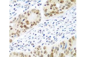 Immunohistochemistry of paraffin-embedded Human colon carcinoma using MDC1 Polyclonal Antibody at dilution of 1:100 (40x lens). (MDC1 抗体)