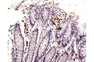 Formalin-fixed and paraffin embedded human colon labeled with Anti-DR3/APO3/TWEAK Polyclonal Antibody, Unconjugated  at 1:200, followed by conjugation to the secondary antibody and DAB staining (DR3/LARD 抗体  (AA 351-417))