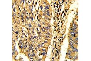 IHC analysis of FFPE human lung carcinoma with HSP60 antibody (HSPD1 抗体  (AA 80-109))
