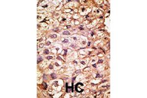 Formalin-fixed and paraffin-embedded human hepatocellular carcinoma tissue reacted with ACE2 polyclonal antibody  , which was peroxidase-conjugated to the secondary antibody, followed by AEC staining. (ACE2 抗体  (AA 59-90))