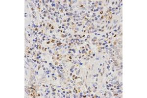 Immunohistochemistry of paraffin-embedded human lung cancer tissue using SCTR antibody at dilution of 1:200 (x400 lens) (SCTR 抗体)