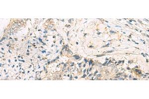 Immunohistochemistry of paraffin-embedded Human cervical cancer tissue using MGAT4B Polyclonal Antibody at dilution of 1:50(x200)