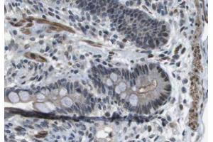 ABIN6266623 at 1/100 staining human colon carcinoma tissue sections by IHC-P.