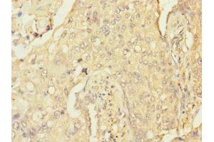 Immunohistochemistry of paraffin-embedded human lung cancer using ABIN7167625 at dilution of 1:100 (RGS 抗体  (AA 230-350))