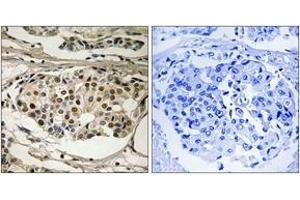 Immunohistochemistry analysis of paraffin-embedded human breast carcinoma, using NF-kappaB p65 (Phospho-Ser281) Antibody. (NF-kB p65 抗体  (pSer281))