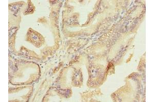 Immunohistochemistry of paraffin-embedded human prostate cancer using ABIN7177750 at dilution of 1:100