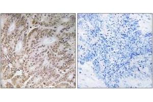 Immunohistochemistry analysis of paraffin-embedded human colon carcinoma tissue, using UBQLN4 Antibody. (UBQLN4 抗体  (AA 201-250))