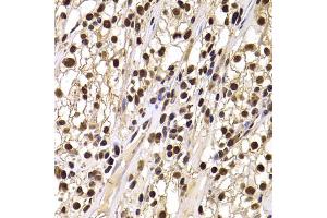 Immunohistochemistry of paraffin-embedded human kidney cancer using HIRIP3 antibody (ABIN2563051) at dilution of 1:100 (40x lens). (HIRIP3 抗体)