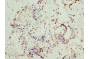 Immunohistochemistry of paraffin-embedded human breast cancer using ABIN7146874 at dilution of 1:100 (CSNK1G1 抗体  (Isoform gamma 1))