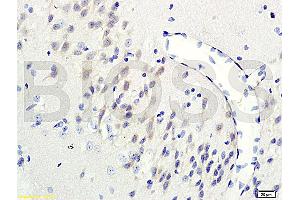 Formalin-fixed and paraffin-embedded human colon carcinoma labeled with Rabbit Anti-GRB2/ASH Polyclonal Antibody (ABIN686932) , Unconjugated 1:200 followed by conjugation to the secondary antibody and DAB staining (GRB2 抗体)