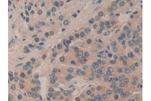 Detection of mTOR in Human Prostate cancer Tissue using Polyclonal Antibody to Serine/threonine-protein kinase mTOR (mTOR) (MTOR 抗体  (AA 2226-2488))