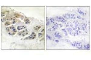 Immunohistochemistry analysis of paraffin-embedded human breast carcinoma tissue using Mammaglobin antibody. (Mammaglobin A 抗体)