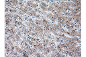 Immunohistochemical staining of paraffin-embedded Carcinoma of liver tissue using anti-SERPINA1mouse monoclonal antibody. (SERPINA1 抗体)
