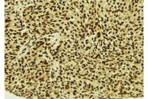 ABIN6274515 at 1/100 staining Human breast cancer tissue by IHC-P. (LASS4 抗体  (N-Term))