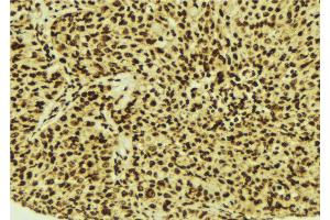 ABIN6274515 at 1/100 staining Human breast cancer tissue by IHC-P. (LASS4 抗体  (N-Term))