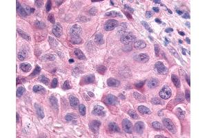 Anti-ESRRA / ERR Alpha antibody IHC of human Lung, Non-Small Cell Carcinoma. (ESRRA 抗体  (Internal Region))