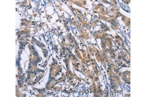 Immunohistochemistry of Human colon cancer using SYT17 Polyclonal Antibody at dilution of 1:60 (SYT17 抗体)