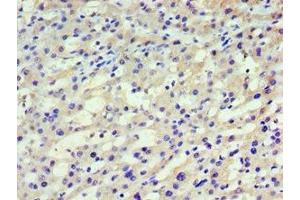 Immunohistochemistry of paraffin-embedded human liver cancer using ABIN7155257 at dilution of 1:100 (HARS1/Jo-1 抗体  (AA 1-180))