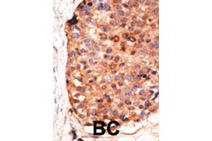 Formalin-fixed and paraffin-embedded human cancer tissue reacted with the APOBEC3G polyclonal antibody  , which was peroxidase-conjugated to the secondary antibody, followed by DAB staining. (APOBEC3G 抗体  (C-Term))