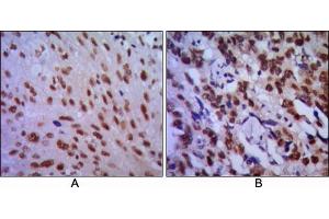 Immunohistochemical analysis of paraffin-embedded human lung cancer (A) and esophageal cancer (B), showing cytoplasmic localization using CDC2 mouse mAb with DAB staining. (CDK1 抗体)