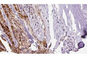 ABIN6267132 at 1/100 staining Human thyroid cancer tissue by IHC-P. (KSR1 抗体  (pSer40, pSer392))