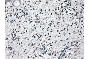 Immunohistochemical staining of paraffin-embedded Adenocarcinoma of breast tissue using anti-BRAF mouse monoclonal antibody. (BRAF 抗体)