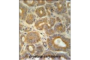 CRABP1 Antibody (C-term) (ABIN651614 and ABIN2840325) immunohistochemistry analysis in formalin fixed and paraffin embedded human prostate carcinoma followed by peroxidase conjugation of the secondary antibody and DAB staining. (CRABP1 抗体  (C-Term))