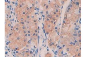 IHC-P analysis of Human Stomach cancer Tissue, with DAB staining. (ANGPTL4 抗体  (AA 182-388))