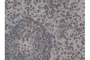 IHC-P analysis of Human Skin cancer Tissue, with DAB staining. (GLG1 抗体  (AA 1048-1145))