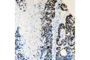Immunohistochemical analysis of FANCD2 staining in human colon cancer formalin fixed paraffin embedded tissue section. (FANCD2 抗体  (N-Term))
