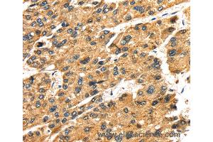 Immunohistochemistry of Human liver cancer using SLC25A26 Polyclonal Antibody at dilution of 1:30 (SLC25A26 抗体)