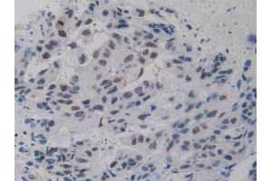 IHC-P analysis of Human Breast Cancer Tissue, with DAB staining. (Nucleolin 抗体  (AA 388-569))