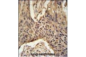 LR4 Antibody (C-term) (ABIN651164 and ABIN2840106) immunohistochemistry analysis in formalin fixed and paraffin embedded human lung carcinoma followed by peroxidase conjugation of the secondary antibody and DAB staining. (LPPR4 抗体  (C-Term))