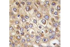 IHC analysis of FFPE human hepatocarcinoma tissue stained with Claudin 2 antibody (Claudin 2 抗体  (AA 135-164))