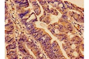 Immunohistochemistry analysis of human colon cancer using ABIN7170866 at dilution of 1:100 (SMC4 抗体  (AA 406-501))
