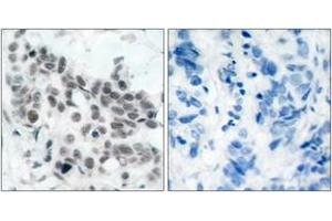 Immunohistochemistry analysis of paraffin-embedded human breast carcinoma, using Retinoblastoma (Phospho-Ser780) Antibody. (Retinoblastoma Protein (Rb) 抗体  (pSer780))