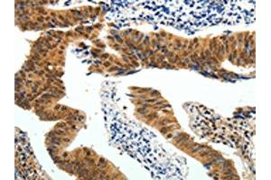 The image on the left is immunohistochemistry of paraffin-embedded Human colon cancer tissue using ABIN7130641(PIWIL4 Antibody) at dilution 1/25, on the right is treated with fusion protein. (PIWIL4 抗体)
