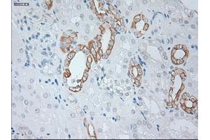 Immunohistochemical staining of paraffin-embedded Carcinoma of kidney tissue using anti-KRT19mouse monoclonal antibody. (Cytokeratin 19 抗体  (AA 240-390))