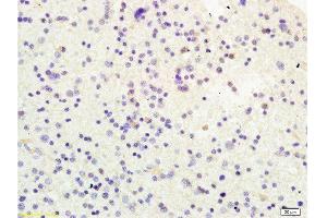 Formalin-fixed and human glioma tissue labeled with Anti-USP-1 Polyclonal Antibody, Unconjugated  at 1:200 followed by conjugation to the secondary antibody and DAB staining (USP1 抗体  (AA 701-785))