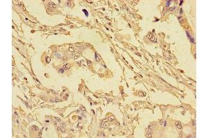 Immunohistochemistry of paraffin-embedded human pancreatic cancer using ABIN7152193 at dilution of 1:100