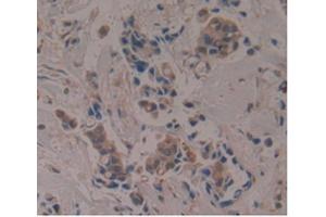 IHC-P analysis of Human Breast Cancer Tissue, with DAB staining. (APOA1BP 抗体  (AA 118-282))