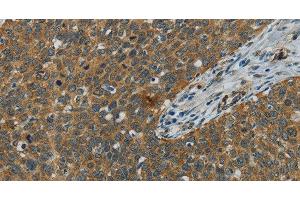 Immunohistochemistry of paraffin-embedded Human cervical cancer using E2F6 Polyclonal Antibody at dilution of 1:60 (E2F6 抗体)
