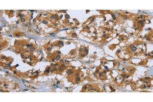Immunohistochemistry of paraffin-embedded Human thyroid cancer using RAP1B Polyclonal Antibody at dilution of 1:50 (RAP1B 抗体)